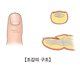 조갑이영양증